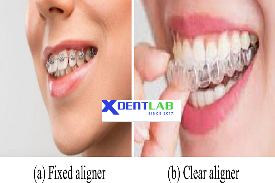 Introduce International orthodontic aligner production